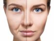 Collagen Supplements Improve Skin Health but Not Wrinkles