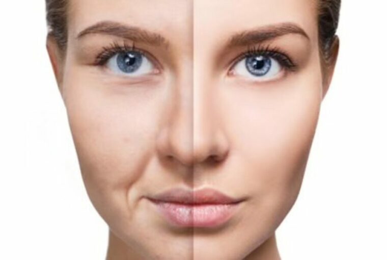 Collagen Supplements Improve Skin Health but Not Wrinkles