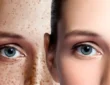 Understanding Melasma