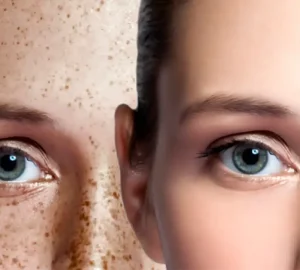 Understanding Melasma Understanding Melasma
