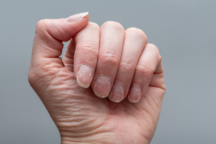 Debunking the Myth: Do White Spots on Nails Indicate Nutritional Deficiencies?