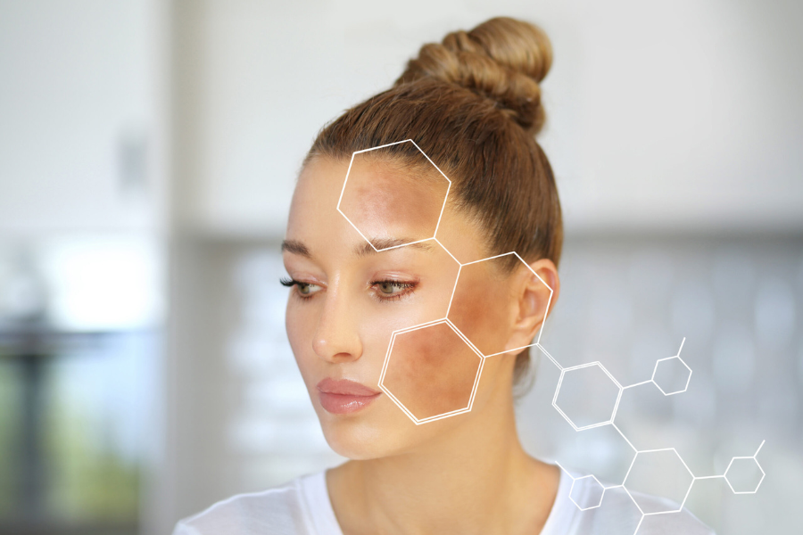 Melasma